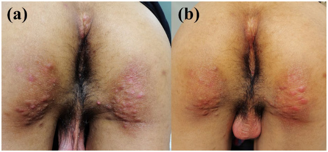 Recalcitrant nodular scabies showing excellent response to tofacitinib: five case reports.