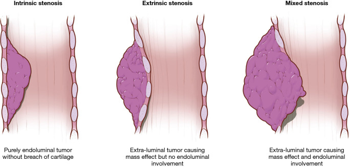 Airway stenting for central airway obstruction: a review.