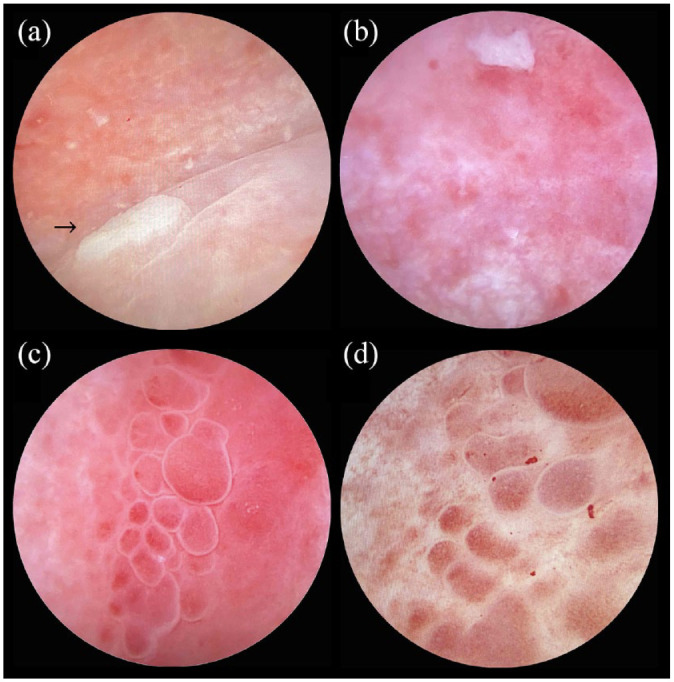 Cytomegalovirus haemorrhagic cystitis in a pregnant patient with AIDS.