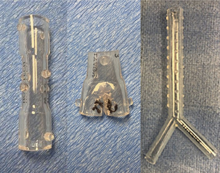 Airway stenting for central airway obstruction: a review.