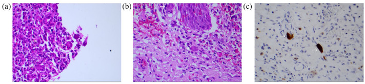 Cytomegalovirus haemorrhagic cystitis in a pregnant patient with AIDS.