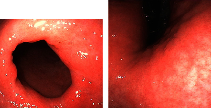 Atypical Presentations of Collagenous Gastritis Mimicking Celiac Sprue.