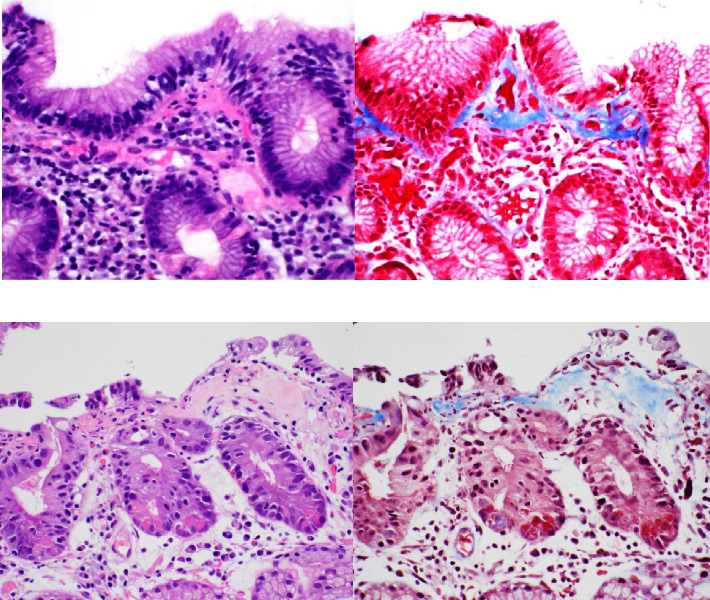 Atypical Presentations of Collagenous Gastritis Mimicking Celiac Sprue.