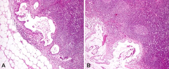 Molecular prognostic factors in colorectal cancer: 5-year follow-up.