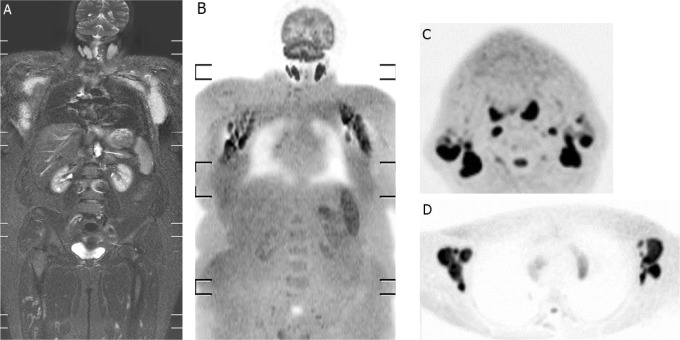 Whole-body diffusion-weighted imaging with background body signal suppression and quantitative apparent diffusion coefficient in the detection, staging, and grading of non-Hodgkin lymphoma.