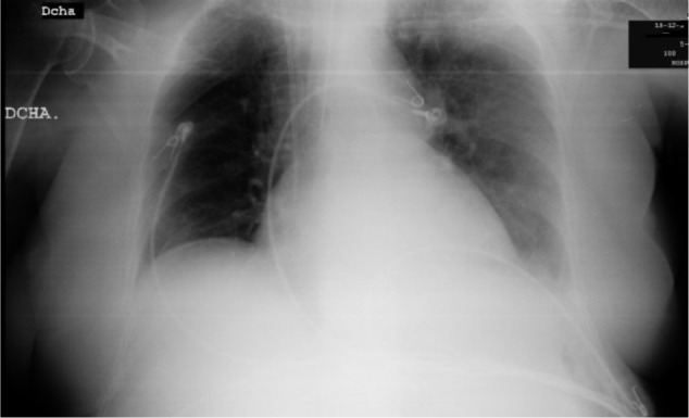 Cardiac tamponade and cardiogenic shock after central venous catheter cannulation. Analysis of a case.