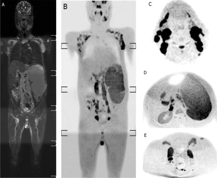 Whole-body diffusion-weighted imaging with background body signal suppression and quantitative apparent diffusion coefficient in the detection, staging, and grading of non-Hodgkin lymphoma.