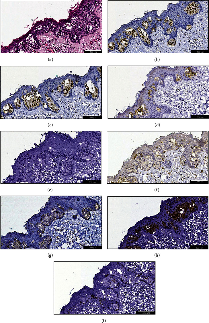 HER2 Negative Mammary Paget's Disease or In Situ Melanoma? A Case Report and Review of the Literature.