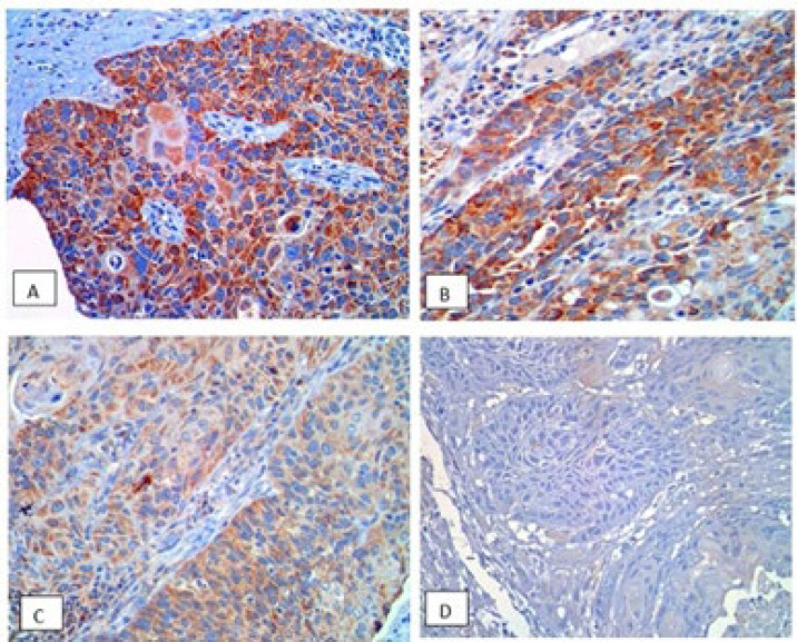 MMP-9 and CCR7 as Possible Predictors of Lymph Node Metastasis in Laryngeal Squamous Cell Carcinoma.