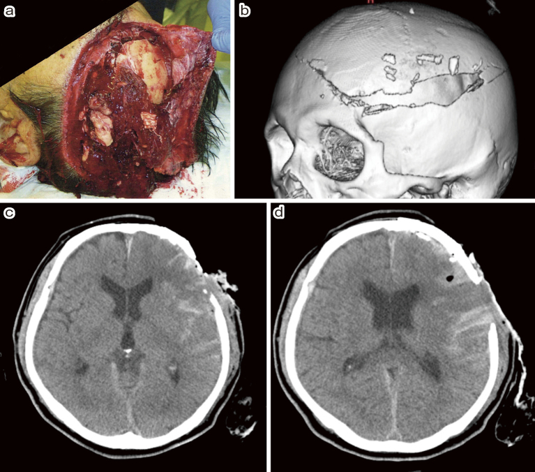 Catastrophic Propeller Brain Injury with Large Scalp Defect Treated with Omental Flap.