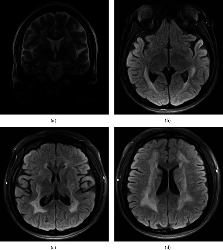 Recurrent Ischemic Strokes due to Monogenic COL4A1 Mutation: The First Case Report from Latin America.