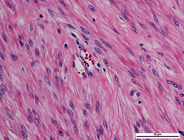 Secondary Erythrocytosis Associated with Uterine Myoma Is Rare but Should Be of Concern.