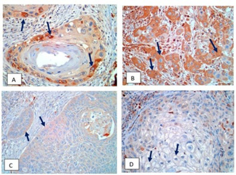 MMP-9 and CCR7 as Possible Predictors of Lymph Node Metastasis in Laryngeal Squamous Cell Carcinoma.