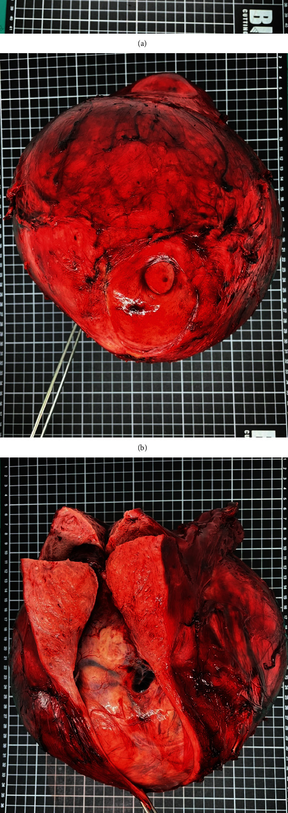 Secondary Erythrocytosis Associated with Uterine Myoma Is Rare but Should Be of Concern.