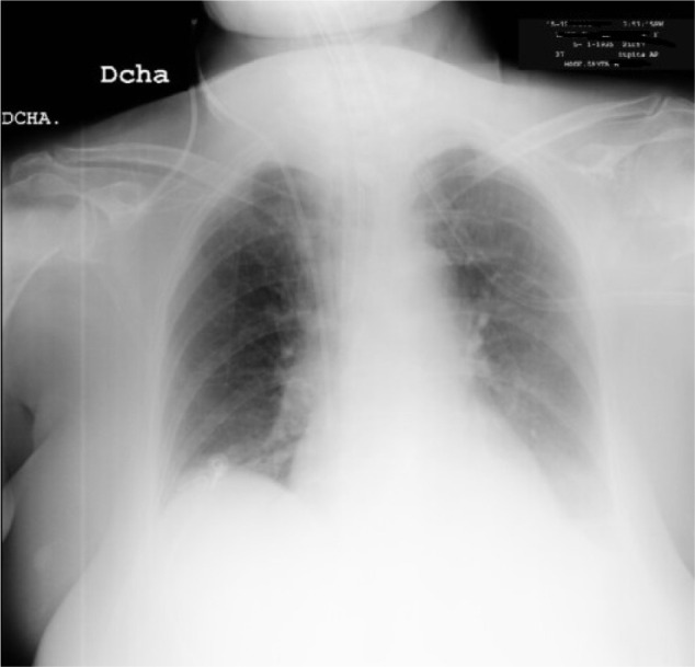 Cardiac tamponade and cardiogenic shock after central venous catheter cannulation. Analysis of a case.