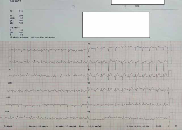 Cardiac tamponade and cardiogenic shock after central venous catheter cannulation. Analysis of a case.