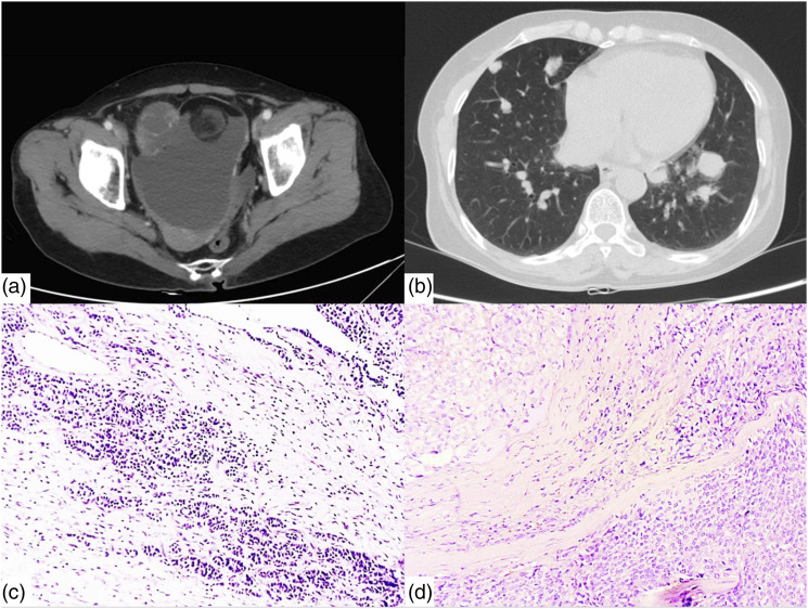 A rare case of synchronous follicular thyroid carcinoma arising within a mature cystic ovarian teratoma and stage IV differentiated thyroid cancer in iodine-deficient area in Viet Nam.