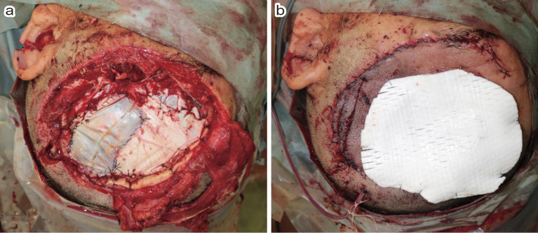 Catastrophic Propeller Brain Injury with Large Scalp Defect Treated with Omental Flap.