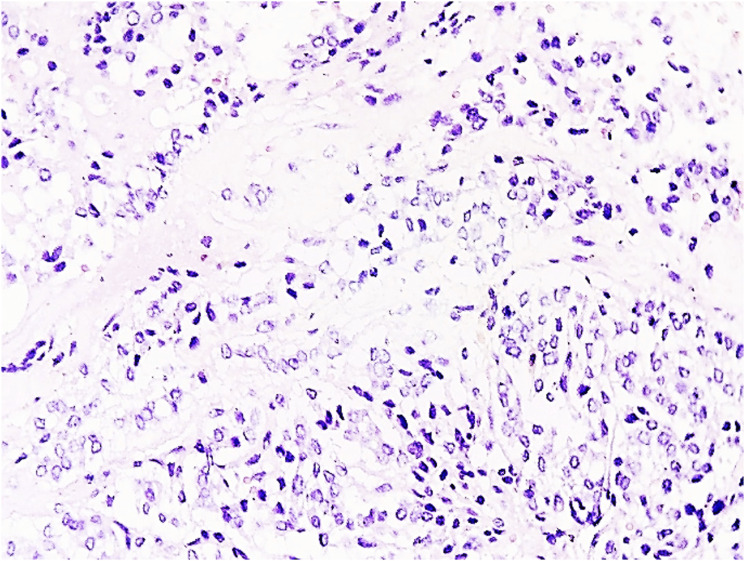 A rare case of synchronous follicular thyroid carcinoma arising within a mature cystic ovarian teratoma and stage IV differentiated thyroid cancer in iodine-deficient area in Viet Nam.