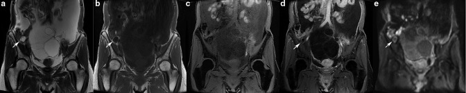 Mucinous tumors arising from ovarian teratomas as another source of pseudomyxoma peritoneii: MR findings comparison with ovarian metastases from appendiceal mucinous tumors.