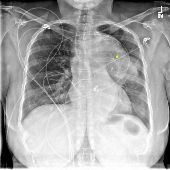 Thoracic Aortic Aneurysm Presenting as a Subacute Cough.