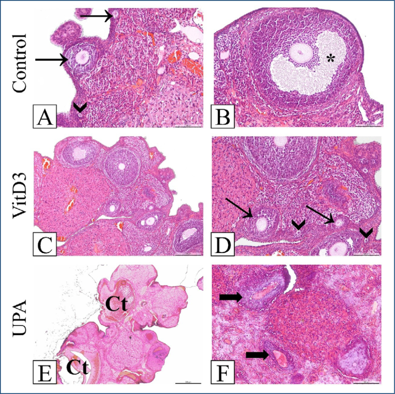 Decreased growth differentiation factor 9, bone morphogenetic protein 15, and forkhead box O3a expressions in the ovary via ulipristal acetate.