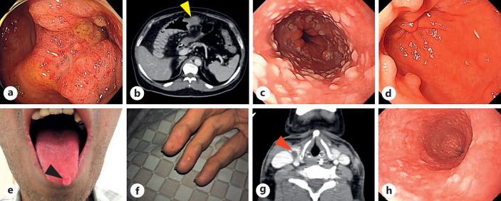 A Patient with Transverse Colon Cancer Complicated by Cowden Syndrome Administered FOLFOXIRI + Bevacizumab Therapy.