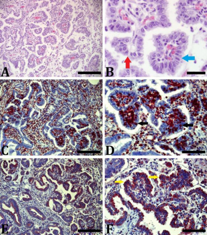 Evaluation of the relationship between inflammatory reaction and interleukins in ovine pulmonary adenocarcinomas.