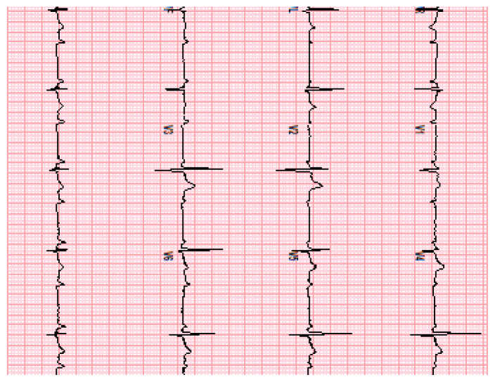 Not Just a Rash: Herpes Zoster-induced Progressive Cardiac Block.