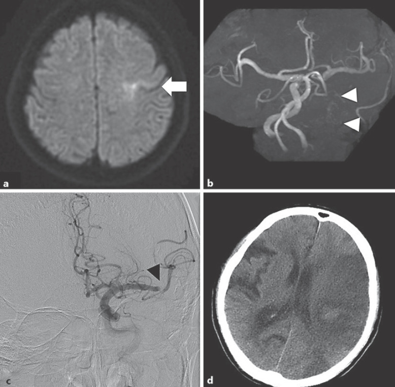 Impact of Patency of the Carotid Terminus and Middle Cerebral Artery on Early Clinical Outcomes in Patients with Acute Internal Carotid Artery Occlusion and Mild Symptoms.