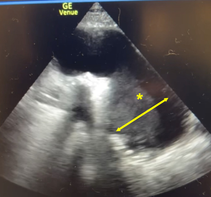 Thoracic Aortic Aneurysm Presenting as a Subacute Cough.