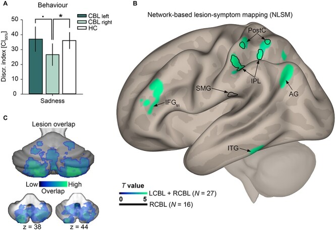 Dysfunctional cerebello-cerebral network associated with vocal emotion recognition impairments.