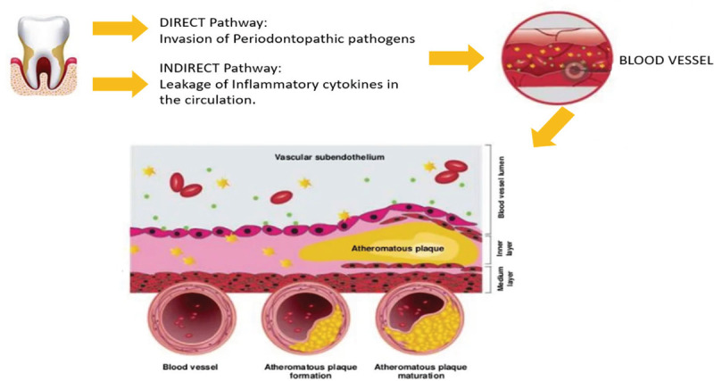 Association between cardiovascular diseases and periodontal disease: more than what meets the eye.