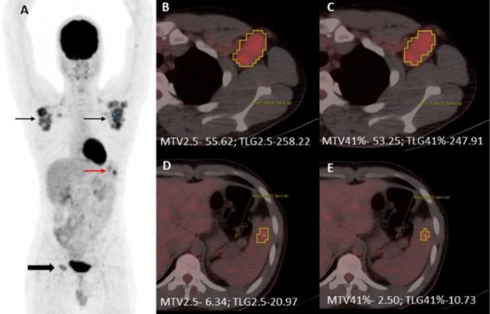 Metabolic tumor parameters complement clinicopathological factors in prognosticating advanced stage Hodgkin Lymphoma.