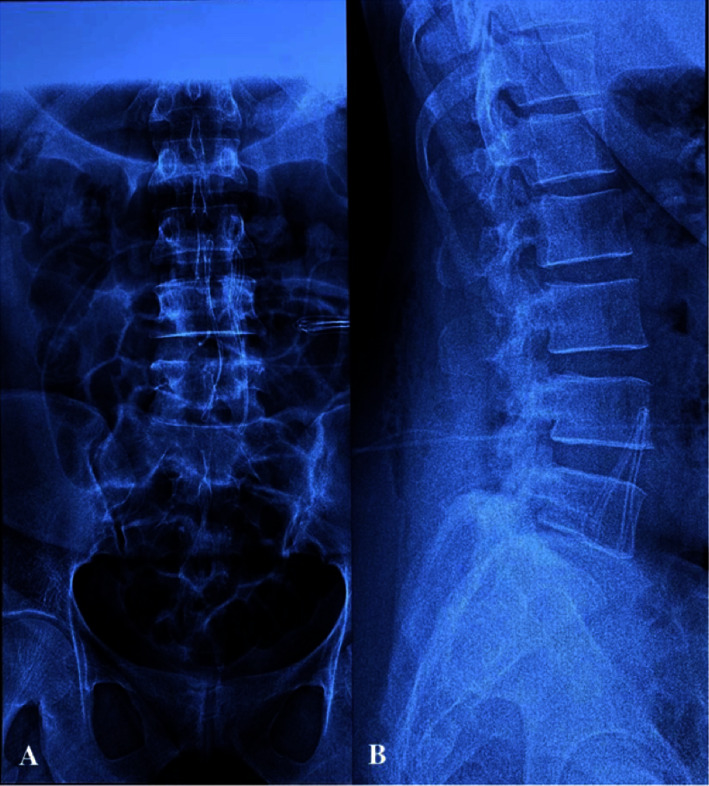 Cesarean Delivery of a Parturient with Lumboperitoneal Shunt under Spinal Anesthesia.