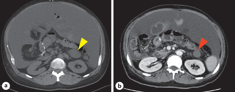 A Patient with Transverse Colon Cancer Complicated by Cowden Syndrome Administered FOLFOXIRI + Bevacizumab Therapy.