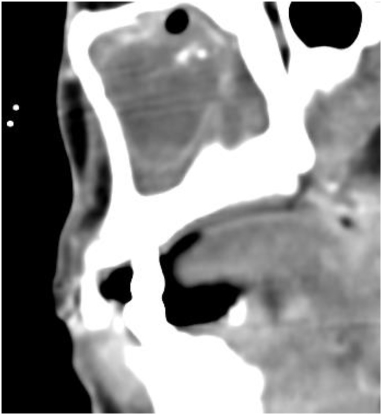 Think outside the box - atypical infections in chronic sinusitis.