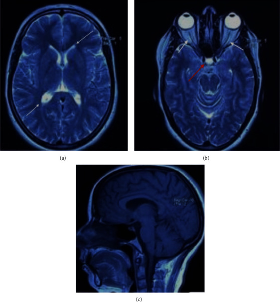 Cesarean Delivery of a Parturient with Lumboperitoneal Shunt under Spinal Anesthesia.