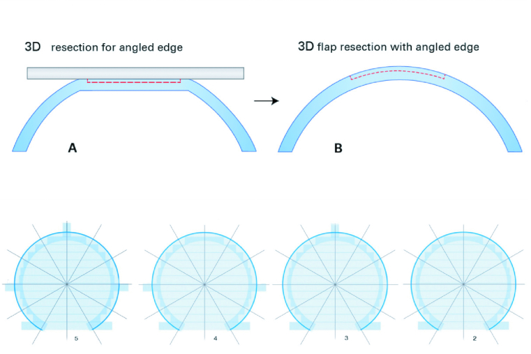 Safety and Precision of Two Different Flap-morphologies Created During Low Energy Femtosecond Laser-assisted LASIK.