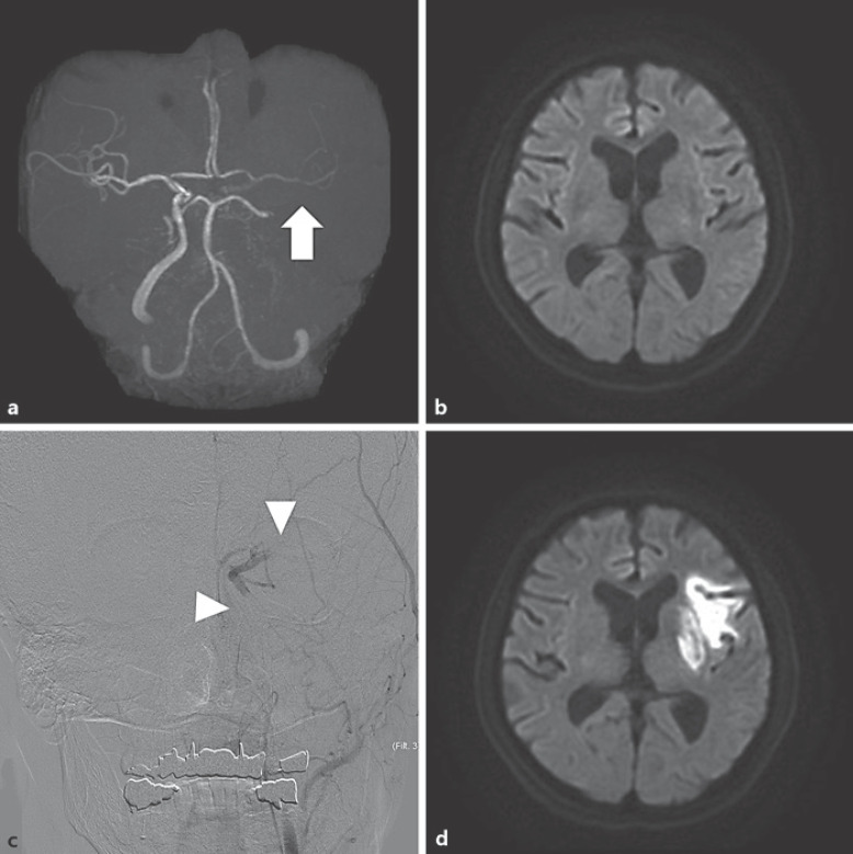 Impact of Patency of the Carotid Terminus and Middle Cerebral Artery on Early Clinical Outcomes in Patients with Acute Internal Carotid Artery Occlusion and Mild Symptoms.