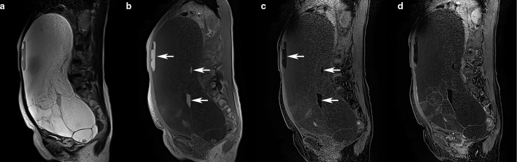 Mucinous tumors arising from ovarian teratomas as another source of pseudomyxoma peritoneii: MR findings comparison with ovarian metastases from appendiceal mucinous tumors.