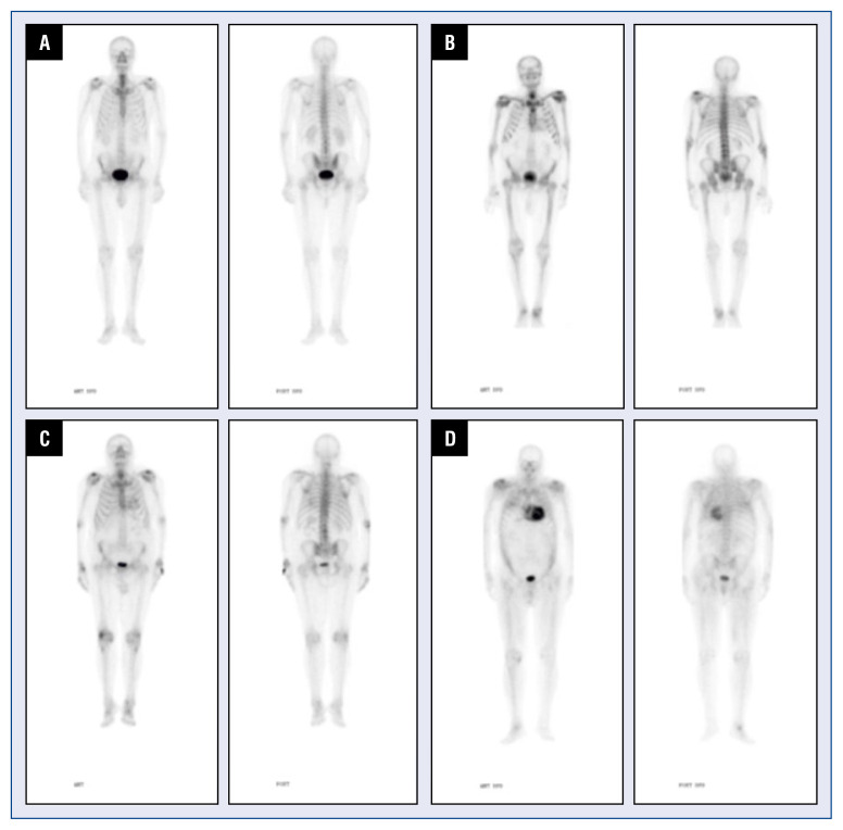 Echocardiographic markers of cardiac amyloidosis in patients with heart failure and left ventricular hypertrophy.