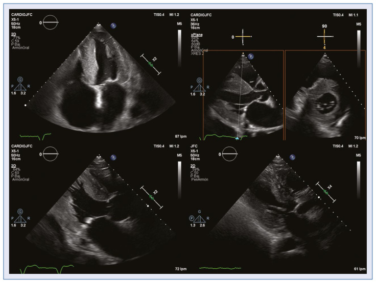 Echocardiographic markers of cardiac amyloidosis in patients with heart failure and left ventricular hypertrophy.