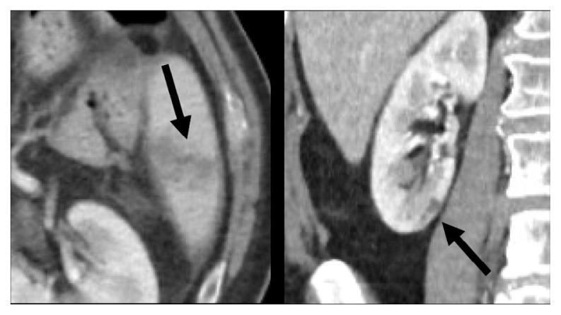 A Case of Catastrophic <i>Aspergillus</i> Endocarditis.