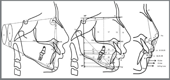 Treatment effects and lip profile changes following premolars extraction treatment vs fixed functional treatment in Class II division 1 malocclusion: A randomized controlled clinical trial.
