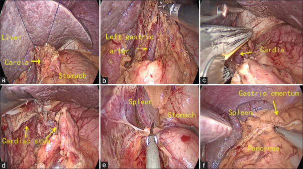 Application of single-port laparoscopic retrograde gastric mobilization during McKeown esophagectomy for esophageal cancer.