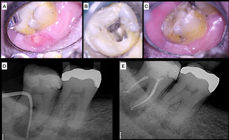 Bioceramic Cements: Supporting in Remineralization of Osteolytic Lesions in Endodontic-periodontal Diseases: A Report of Two Cases.