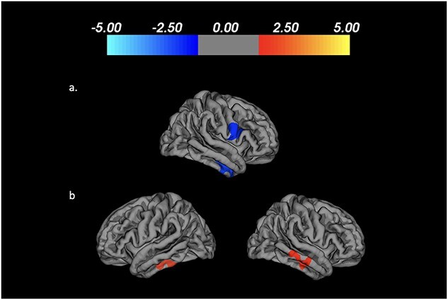 Cerebral cortical thickness and cognitive decline in Parkinson's disease.