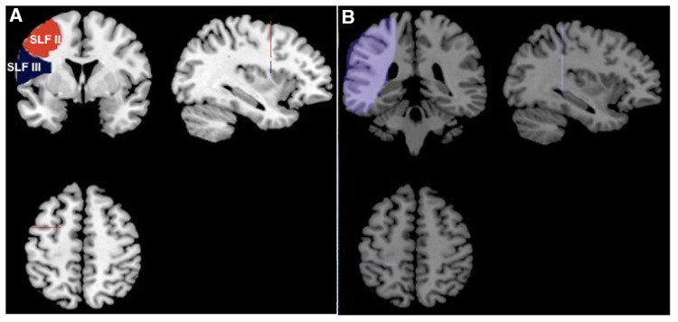 Language function of the superior longitudinal fasciculus in patients with arteriovenous malformation as evidenced by automatic fiber quantification.