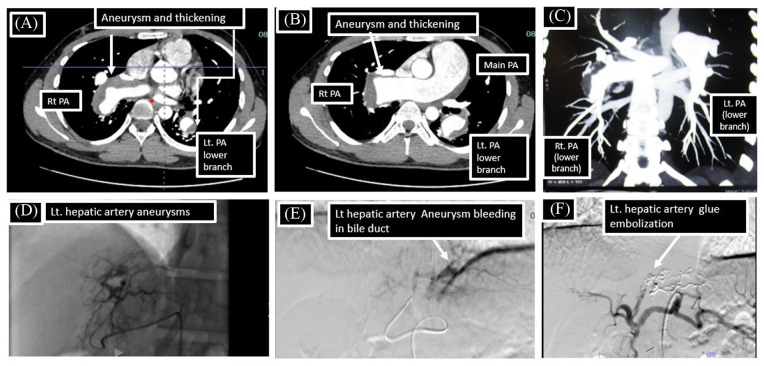 Hughes-Stovin Syndrome: An Experience of Management of 3 Cases From a Tertiary Health Care Centre.